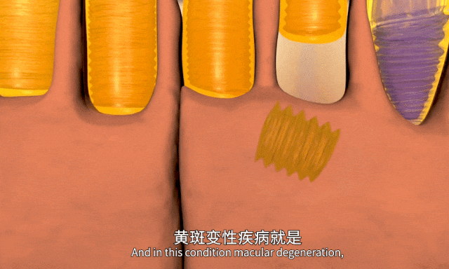 泪液、房水中外泌体的液体活检示意